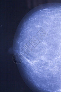 用肿瘤对乳房进行X光检查医疗生长摄影放射科x线疾病x射线卫生肿瘤学射线背景图片