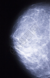 用肿瘤对乳房进行X光检查射线放射科药品疾病生长摄影病人肿瘤学医疗女性图片