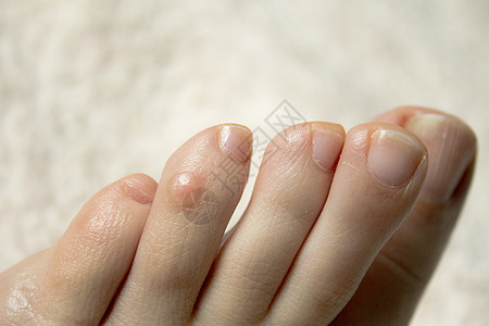 带真菌的脚趾甲白色赤脚治疗治愈医生身体医疗疼痛指甲药品图片