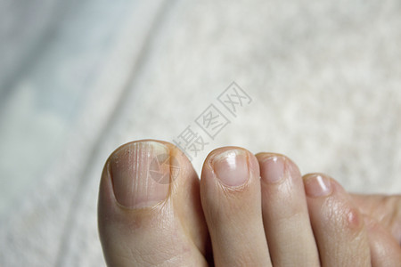 带真菌的脚趾甲白色修脚指甲变形身体治疗治愈医疗医生菌类图片