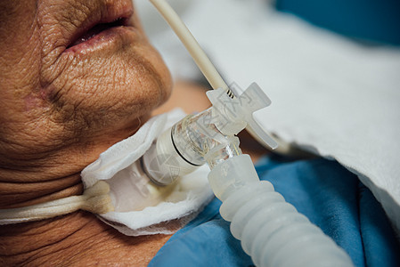 病人在医院做气管切除术和呼吸器诊所气管房间管子外科实验室呼吸科学老年护士图片