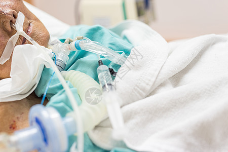 病人在医院做气管切除术和呼吸器成人气管女性房间实验室管子疾病手术保健药品图片