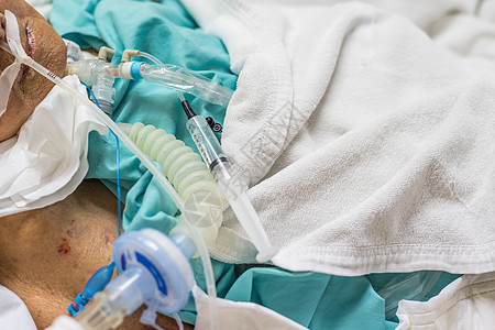 病人在医院做气管切除术和呼吸器护理身体病房诊所呼吸女孩管子手术卫生医生图片