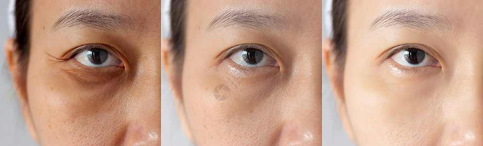 周界防范三张图片治疗前后效果对比 黑眼圈 浮肿 眼周皱纹问题前后治疗 解决肌肤问题 改善肌肤背景
