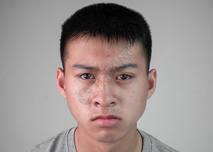 一个穿着灰色 t 恤 有皮肤问题的年轻英俊少年的画像 十几岁的家伙脸上长满粉刺 灰色背景中孤立无援图片