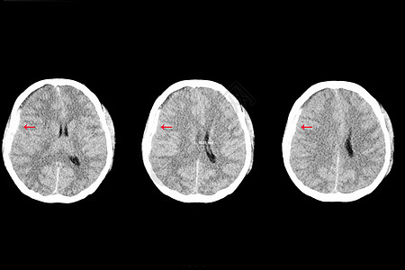 亚硬膜下出血和脑水肿图片