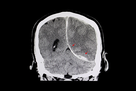 脑部CT 后宫内出血图片