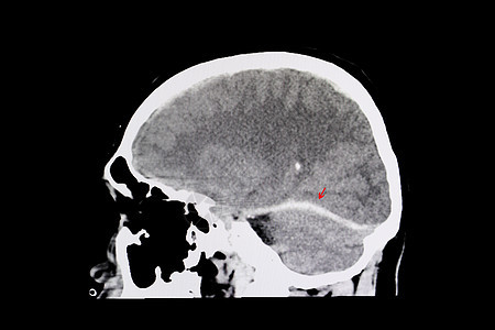 脑内出血外科肿胀射线x射线解剖学手术药品颅骨情况疝气图片