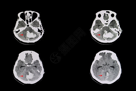 小脑出血医院扫描中风x射线解剖学电影药品诊断手术颅骨图片