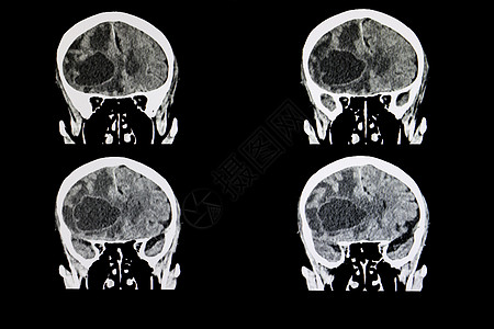 转移性脑肿瘤扫描浮肿医院医疗电影疾病医生情况x射线射线图片