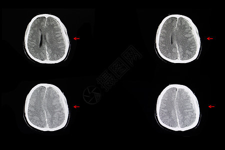 内出血和脑水肿图片