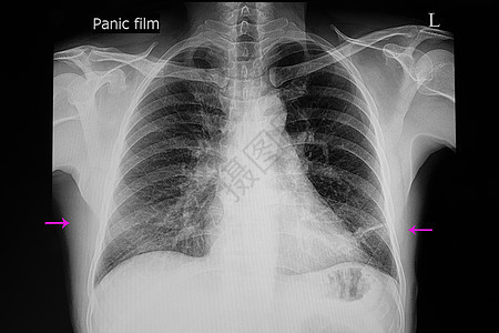 右下部肺肺肺炎图片
