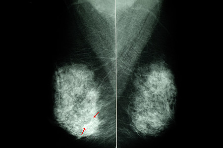 女性乳房乳房X光照片外科技术辐射x射线射线胸部医生诊所医院结节图片