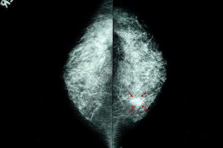女性乳房乳房X光照片辐射x光存款手术射线摄影诊所疾病x射线诊断图片