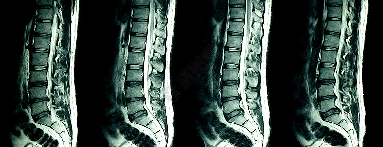 MRI 对患有慢性背部疼痛病人的腰脊椎进行核磁共振扫描治疗医院医生骨骼疾病测试手术学习谐振仪器图片