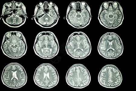 MRI 病人脑部MRI扫描信号测试药品骨骼神经解剖学仪器实质诊断疾病图片