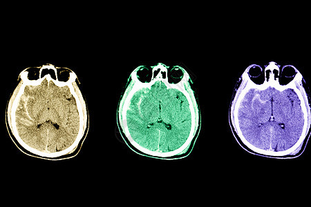 亚氨基甲酸酯出血下腔骨骼电脑电影颅骨医院疾病手术身体扫描图片