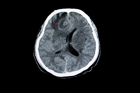 脑口腔硬化感染断层大脑解剖学药品疾病电影治疗x射线诊断扫描图片