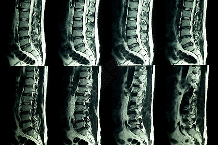 MRI 对患有慢性背部疼痛病人的腰脊椎进行核磁共振扫描压缩诊断光盘教育医院解剖学考试谐振腰椎技术图片