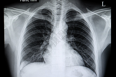 对肺部病人的X光片图片