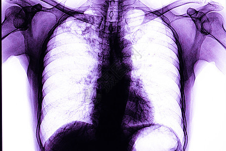 肺肺肺结核电影图片