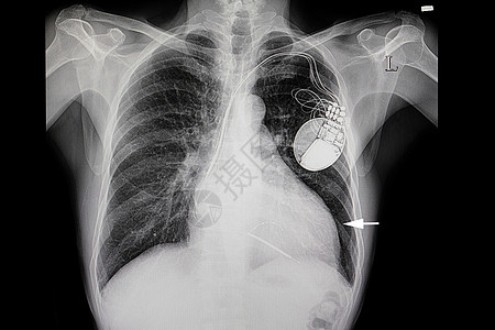 心脏病发作和心脏起搏器的病人图片