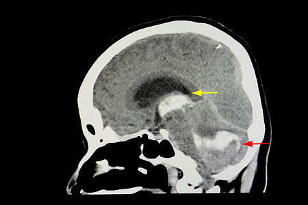 CT 脑扫瞄病人解剖学射线医生骨骼身体疾病电影药品治疗断层图片