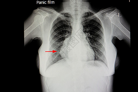 肺大中间介质图片