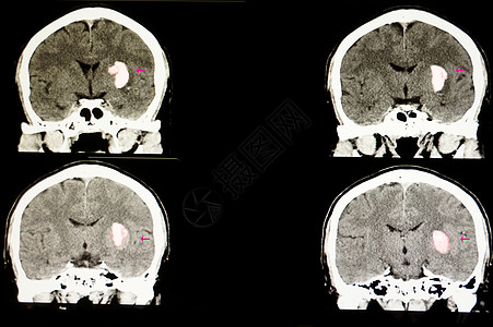 脑部有大血肿的病人紧迫感神经断层切除术情况手术药品中风外科医生图片