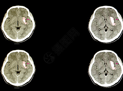 脑部有大血肿的病人疾病电影切除术x射线医院药品断层颅骨扫描中风图片