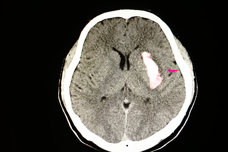 CT扫描脑内出血图片
