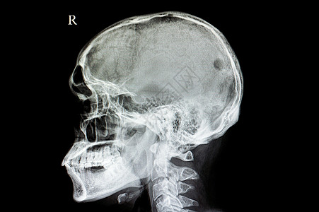 头骨缺陷图片