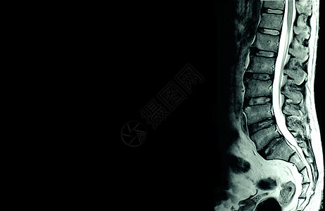 MRI 对患有慢性背部疼痛病人的腰脊椎进行核磁共振扫描教育骨科考试谐振仪器外科光盘医生医院骨骼图片