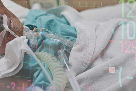 病人在医院做气管切除术和呼吸器心率呼吸机卫生疾病女孩通风诊所单元手术服务图片
