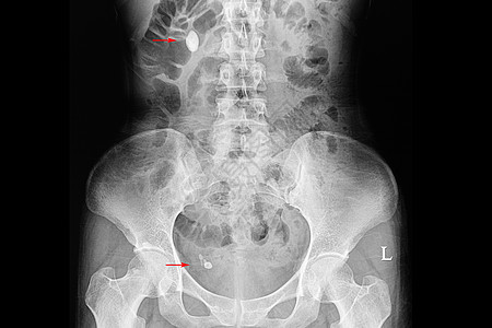 一名多肾和尿道结石患者的X光片图片