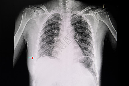 显示腹腔自由空气的病人胸前X光片图片