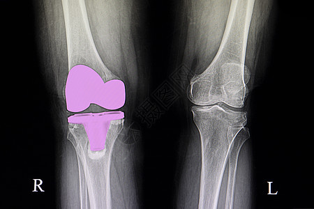 膝关节活性全面医疗身体外科药品射线电影诊断骨科白色x光图片