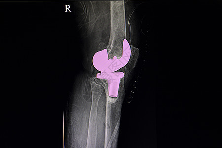 膝关节活性全面医生病人诊断放射科疾病电影解剖学替代品外科身体图片
