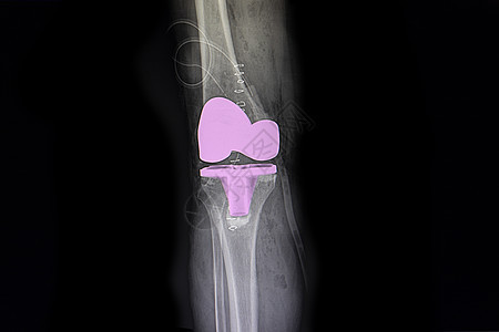 膝关节活性全面电影医院替代品放射科骨骼医生医疗身体疾病x光图片