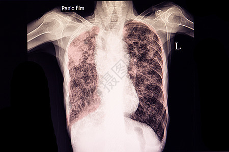 严重肺结核图片