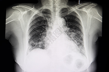 心脏衰竭病人胸部X光片图片