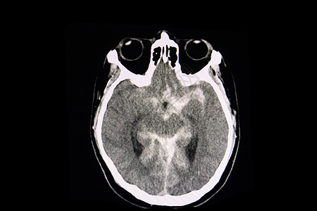 亚氨基甲酸酯出血半球射线手术情况紧迫感血肿疾病事故交通x射线图片