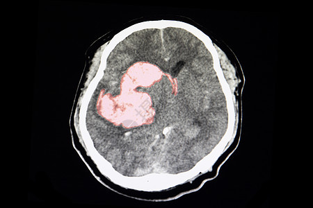 对中风病人进行CT扫描图片