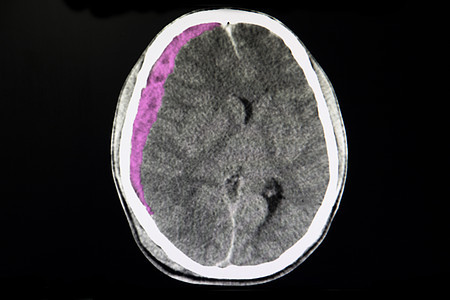 急性亚硬膜下血肿诊断扫描放射科医生治疗疾病浮肿断层电影解剖学图片