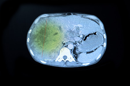 肝瘤图片