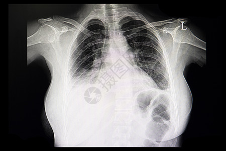 胸部X光薄膜 一个病人的心胸和胸腔骨纤维图片