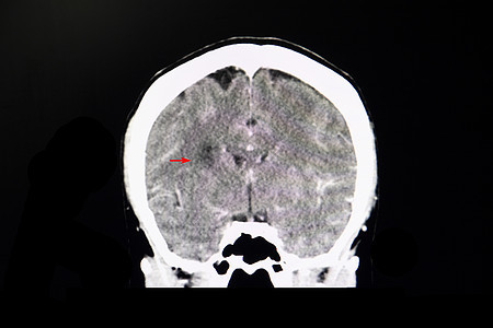 与中风病人相比的CT大脑图片