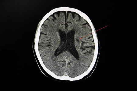 中风病人的CT大脑疾病解剖学弱点糖尿病x射线并发症手术电影放射科截瘫图片