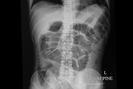 X光片 一个病人的肠道阻塞医院扫描卫生x射线保健解剖学电影直肠乙状气体图片