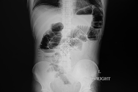 X光片 一个病人的肠道阻塞卫生骨骼阶梯诊断结肠男性x射线科学解剖学冒号图片